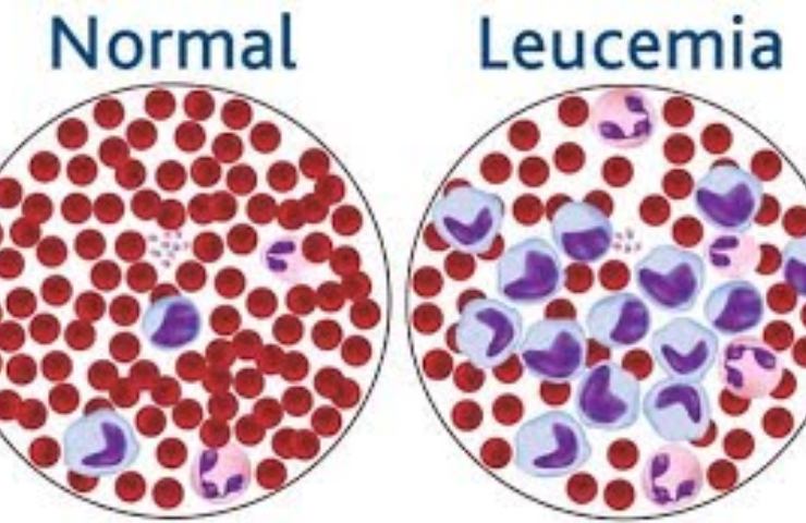 leucemia fulminante