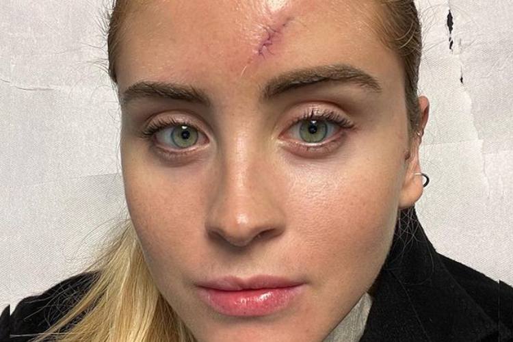 valentina ferragni cicatrice operazione brufolo