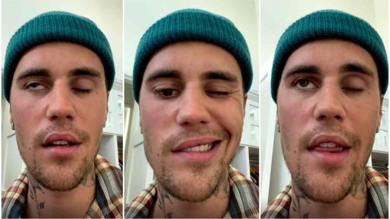Justin Bieber paralisi facciale 