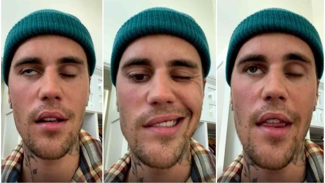 Justin Bieber paralisi facciale