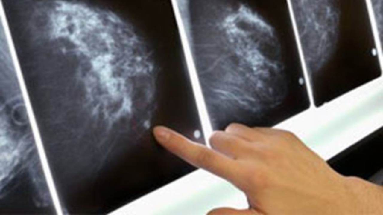 Tumore al seno chesuccede20220621
