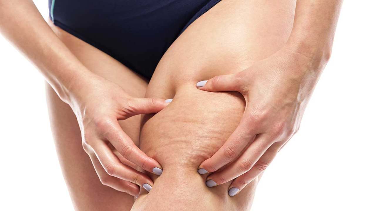 Cellulite inestetismo (Fonte web)