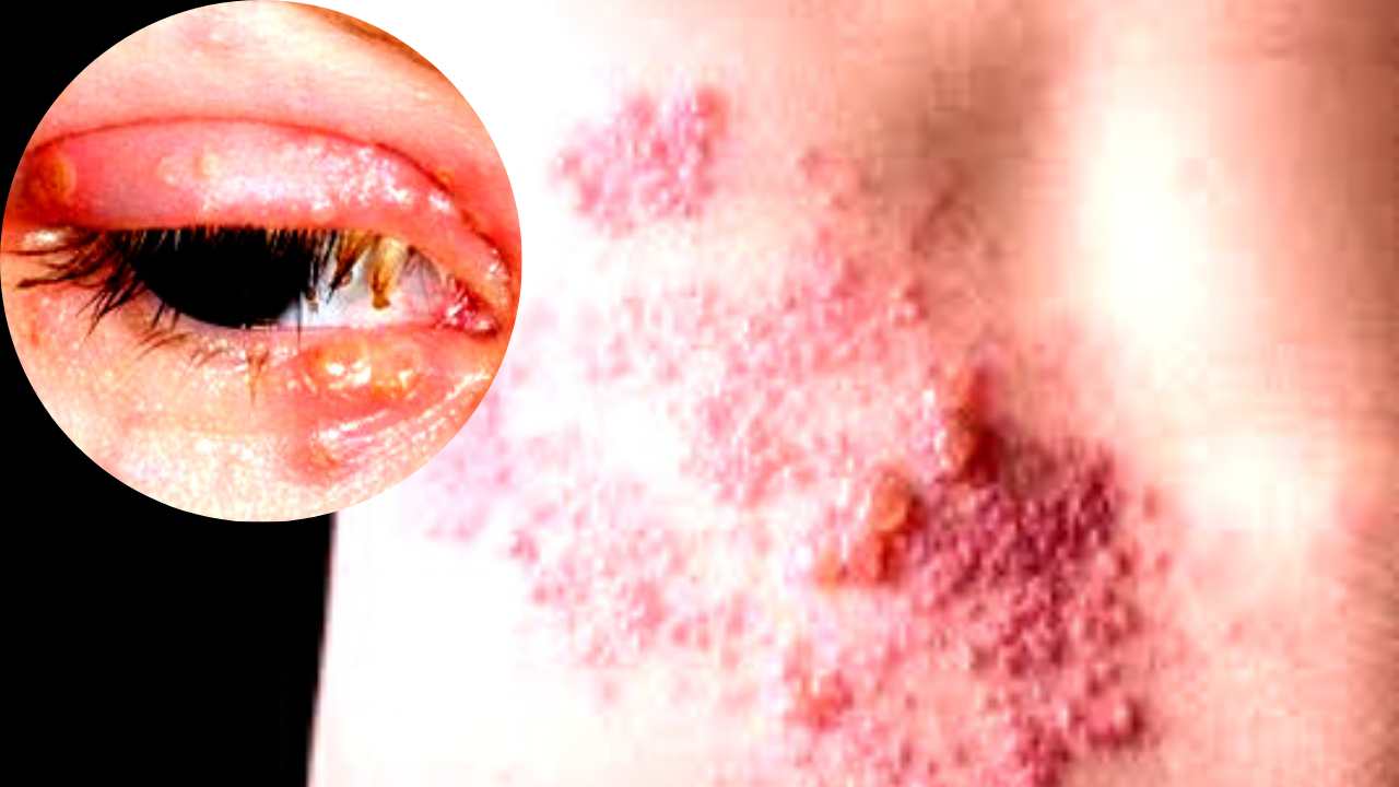 Herpes Zoster (chesuccede.it)