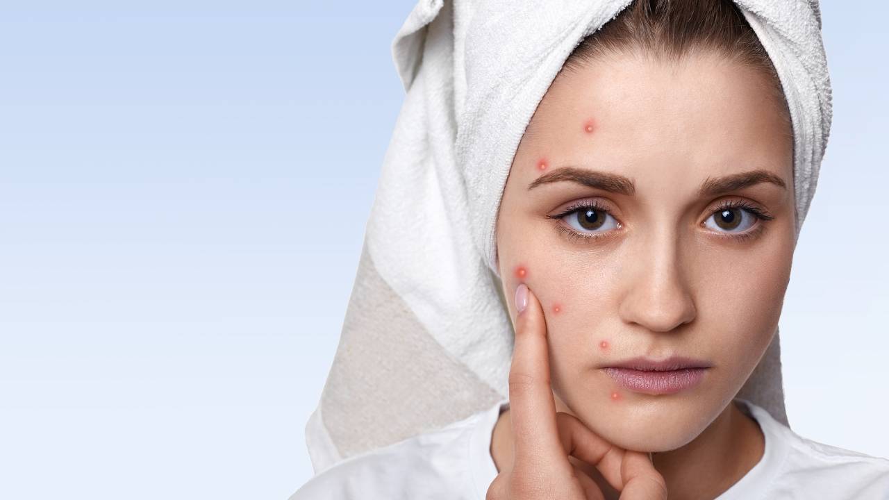 Problema dell'acne