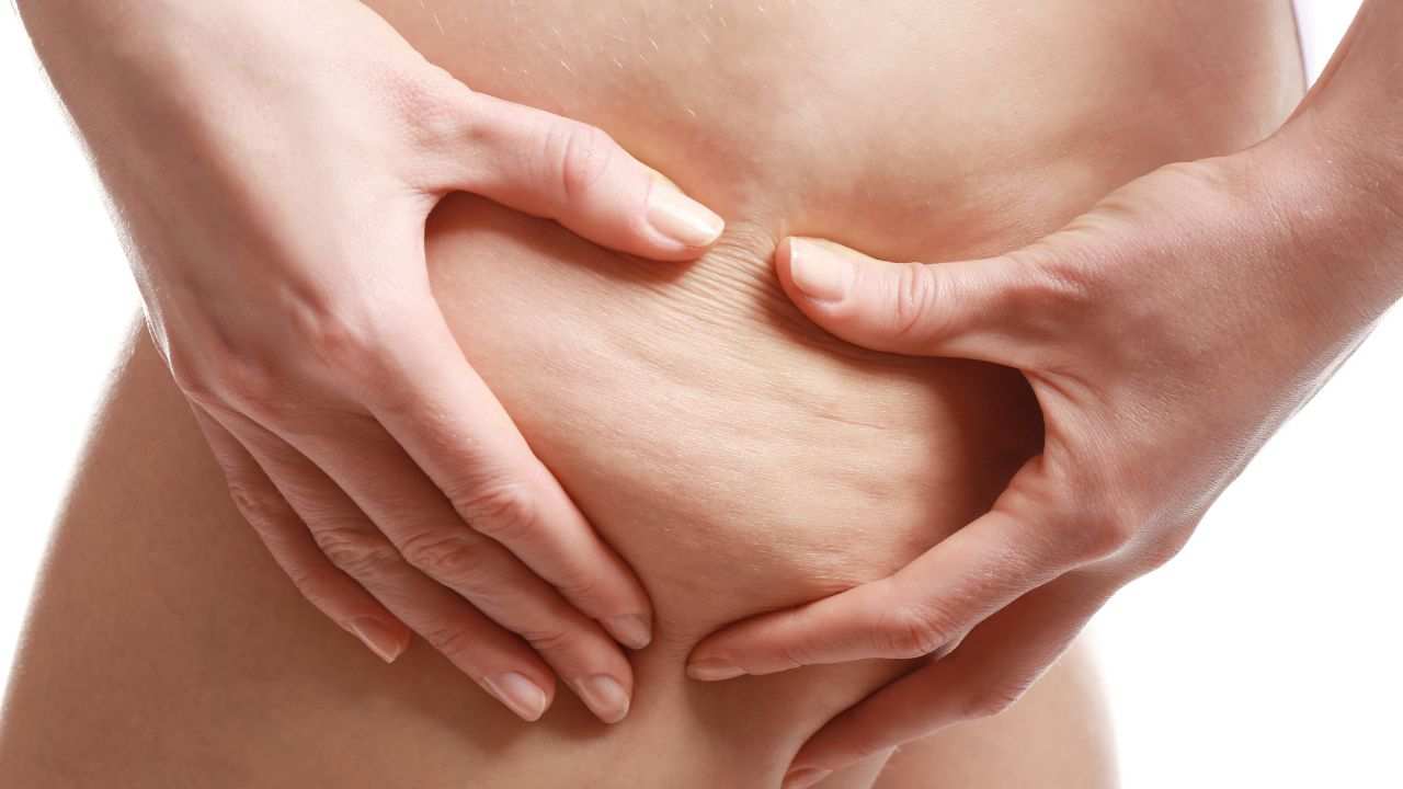 Cosa aumenta la cellulite?